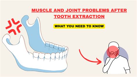 Image result for Problems After Tooth Extraction