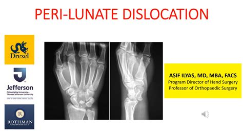 Image result for Lunate Dislocation Reduction