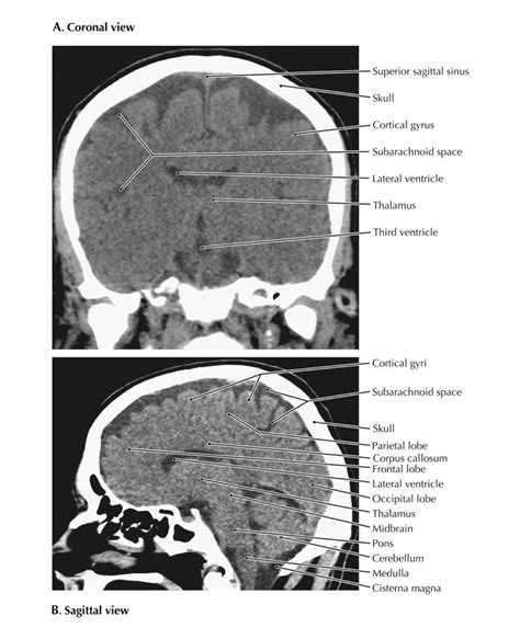 Normal Brain Ct Anatomy