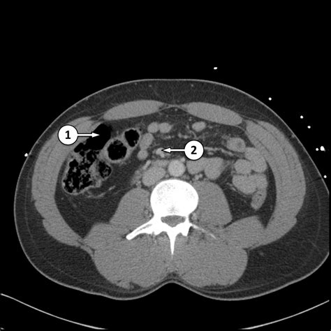 Normal Ct Scan Abdomen