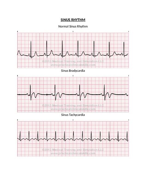 Coronary Assignment Sinus Rhythm Analysis - Scholarfriends