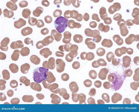 Mantle Cell Lymphoma in Peripheral Blood. Stock Photo - Image of blood, lymphoma: 283530718