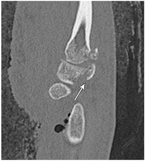 Imaging Diagnosis and Management of Carpal Trauma and Instability—An ...