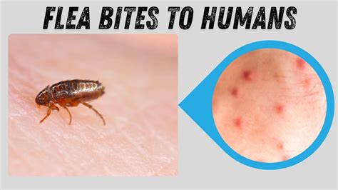 What Do Flea Bites Look Like on Humans? Id with Images