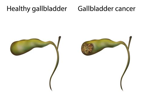 Image result for Gallbladder Cancer