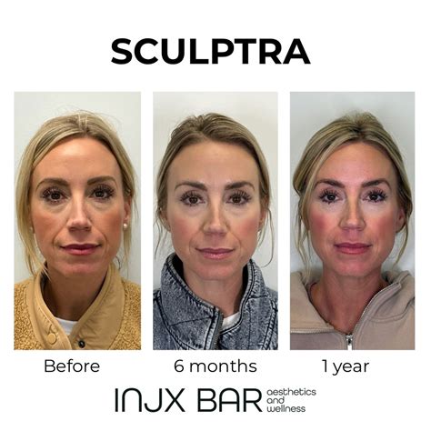 Sculptra Filler Injections: Temples, Butt Lift & More in Peoria, AZ