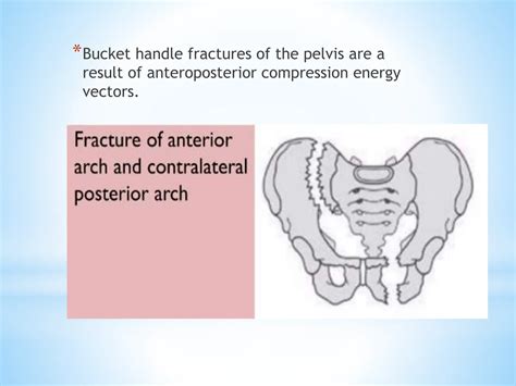 Fractures of the Pelvis bone and its physiotherapy rehabilitation .pptx