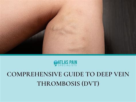 DVT Pain 的图像结果