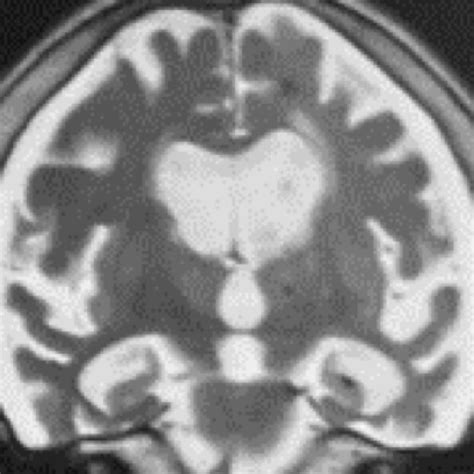 Image result for Diffuse Atrophy