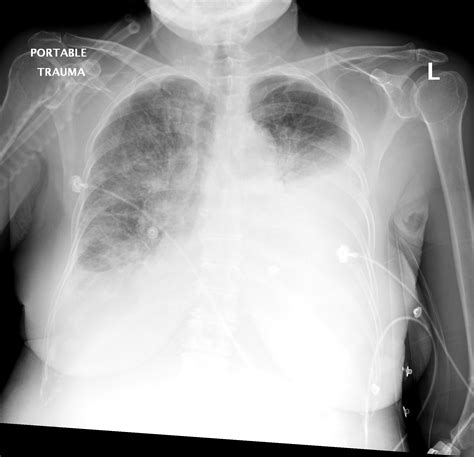 Noncardiogenic Pulmonary Edema Cxr
