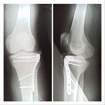 Proximal tibia - plate
