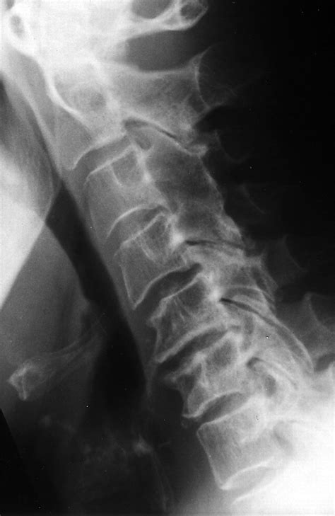 Cervical Ankylosing Spondylitis X Ray