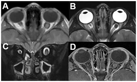 Orbital Tumors—Clinical, Radiologic and Histopathologic Correlation