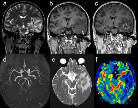 Central Nervous System Vasculitis