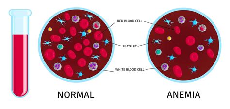 Anemia is not always a simple problem - Dr.K.Raghu