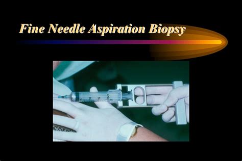 Fine Needle Aspiration Definition at Mark Cox blog