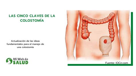 LAS CINCO CLAVES DE LA COLOSTOMÍA