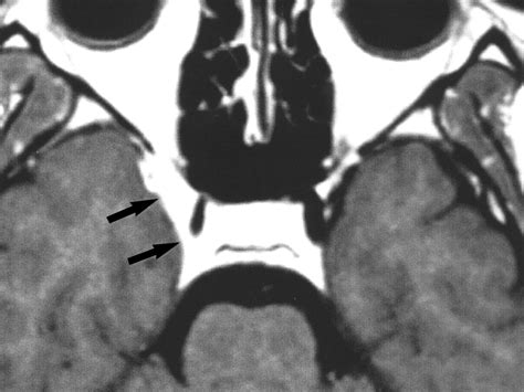 Cavernous Sinus Mri Cavernous Sinus Syndrome: Clinical Features And