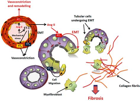 The Key Role of Epithelial to Mesenchymal Transition (EMT) in ...