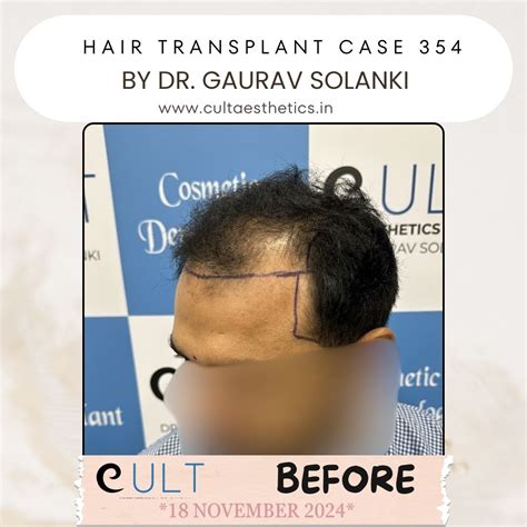 Hair Transplant Results 354 | Cult Aesthetics
