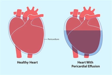 Pericardial Effusion: Causes, Symptoms, Diagnosis & Treatment