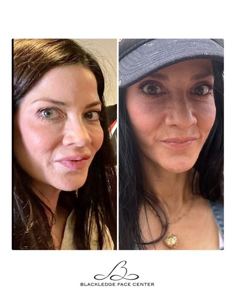 Blackledge Face Center (@blackledgefacecenter) • Instagram photos and ...