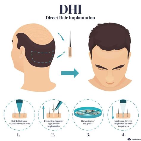 DHI Hair Transplant UK | Guide 2024 | Hairpalace Clinic