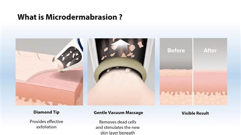 India's first at-home Microdermabrasion Kit, How does the Skince Essen ...