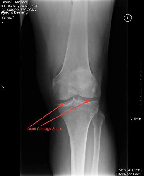 Pain In Knee But Xray Normal at Brenda Sherman blog