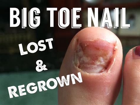 What Does A Toenail Look Like When It Starts To Grow Back at Angus Muir blog