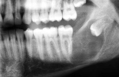 Keratocystic Odontogenic Tumor