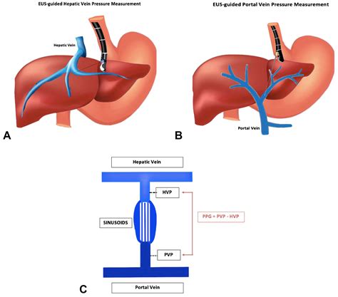 Portal pressure measurement: Have we come full circle? - Gastrointestinal Endoscopy