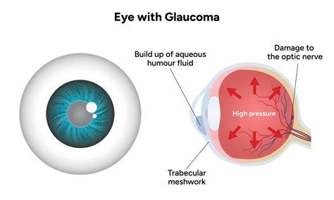 Understanding Glaucoma: Types & Awareness Guide