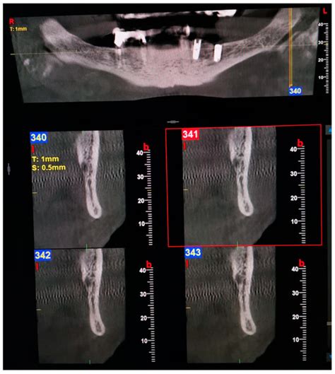 Cone-Beam Computed Tomography Assessment of Bifid and Trifid Mandibular ...