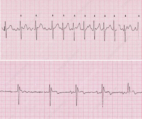 Image result for Cardioversion Steps