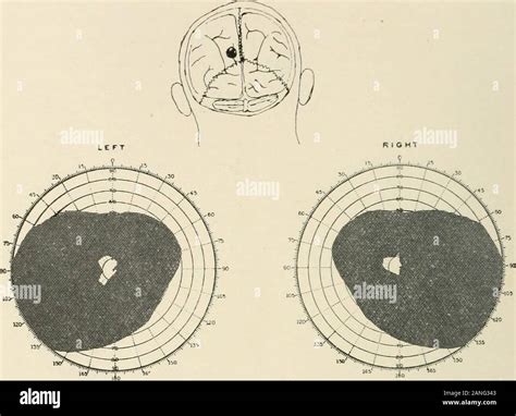 AMAarchives of neurology & psychiatry . Fig. 1 (Case 1, P. B.).—Left parieto-occipital wound and ...