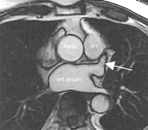 Percutaneous Left Atrial Appendage Transcatheter Occlusion (PLAATO): Planning and Follow-Up ...