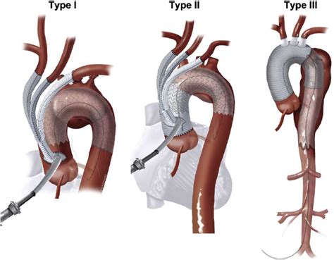 Association between Aortic Remodeling and Stent Graft-Induced New Entry in Extensive Residual ...