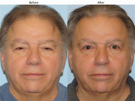 Facial Plastic Surgery: Lazy eye, Ptosis repair, Upper blepharoplasty, Levator advancement ...