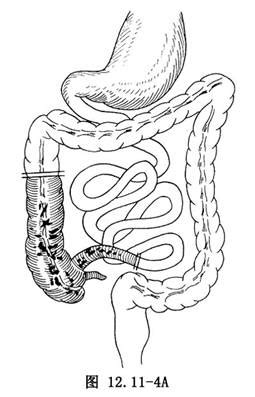 新生儿坏死性小肠结肠炎的手术_什么是新生儿坏死性小肠结肠炎的手术_医学百科