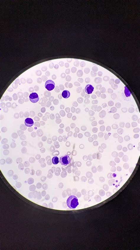 Plasma cell Leukaemia : r/Hematology