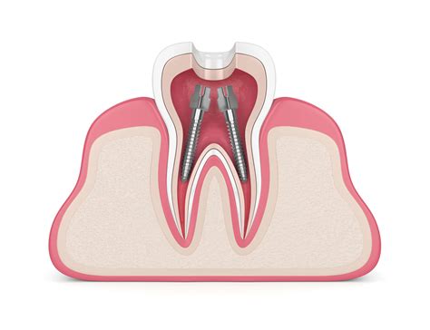 What Is Root Canal Work In Dentistry at Walter Paul blog
