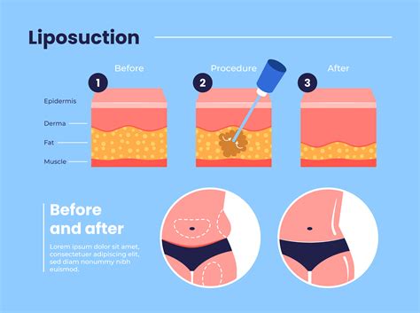Liposuction Cost in Bangalore | Fat Removal Surgery Price
