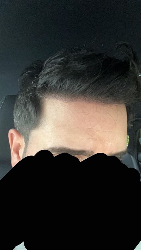 6 Months Today! Progress : r/HairTransplants