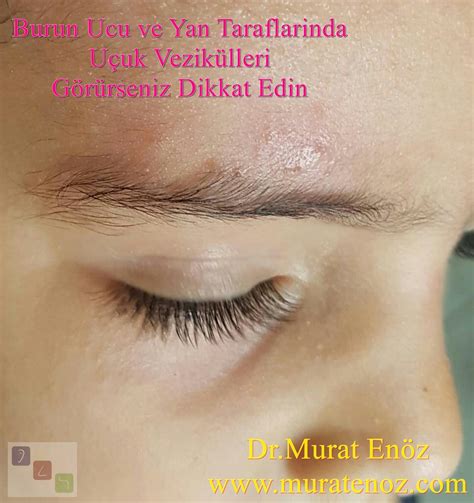 Ophthalmic Herpes Virus Infection and Hutchinson Sign