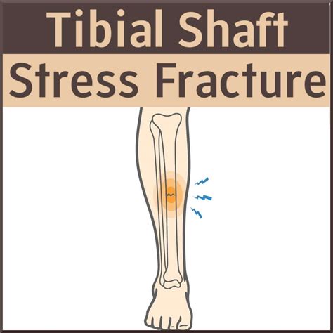 Stress Fracture Tibia Bone Scan