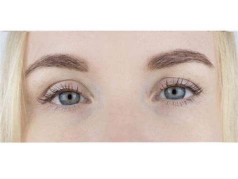 Image result for Thread Lift Problems