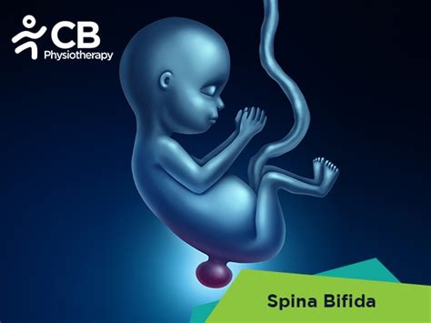 Best Treatment for Spina Bifida in Ghaziabad | Book Appointment with ...