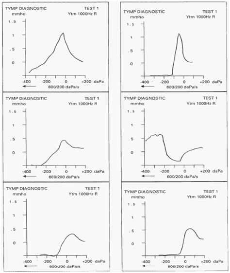 Tympanometry test, tympanometry types & abnormal tympanometry results
