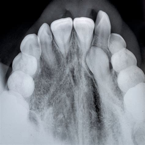 Impacted Canine Tooth